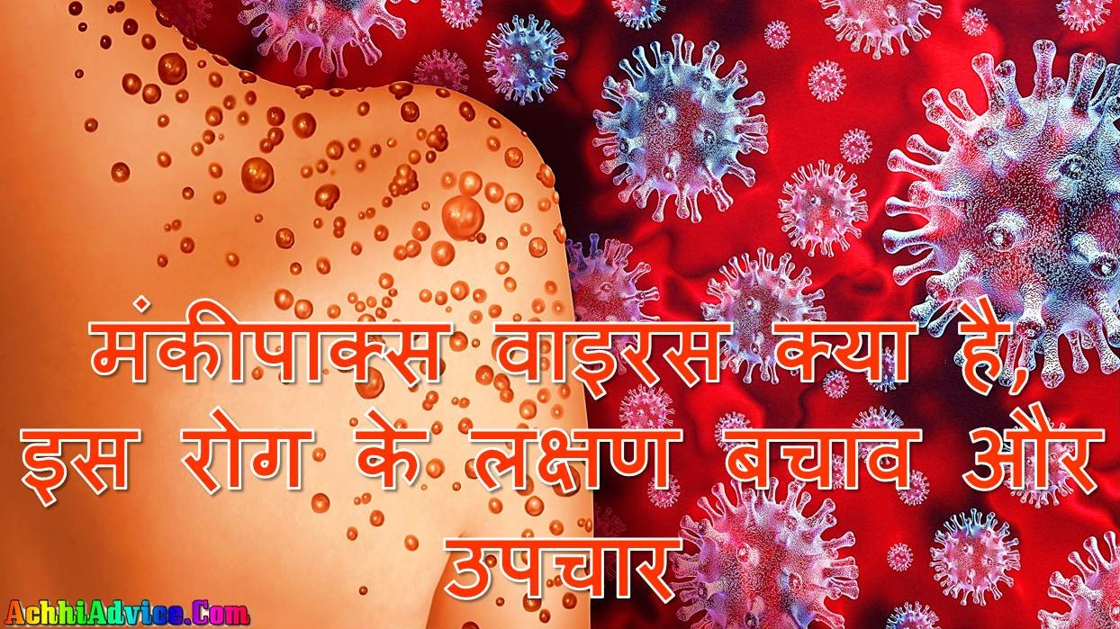 Monkeypox Virus in Hindi